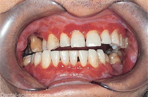 Differential Diagnosis Of Red Lesions Of Oral Cavity Dental Science