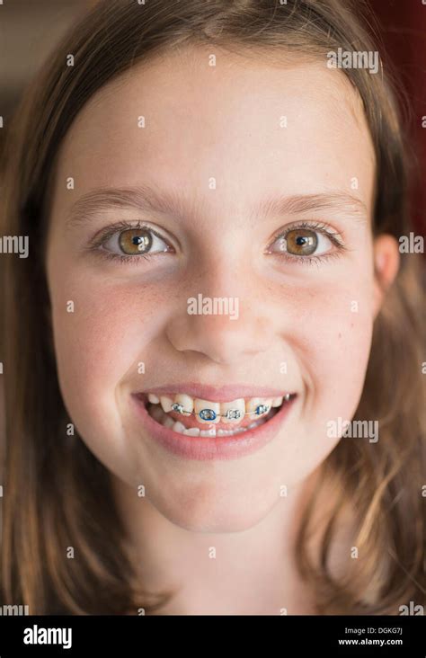 Braces Open Mouth Smile Hi Res Stock Photography And Images Alamy