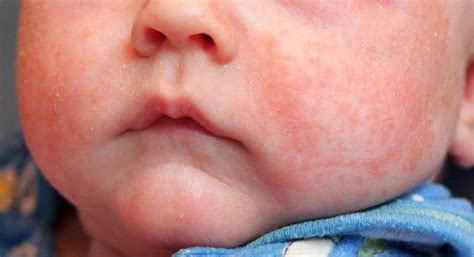 Prickly Heat Rash Baby Face How To Get Rid Of A Baby S Heat Rash