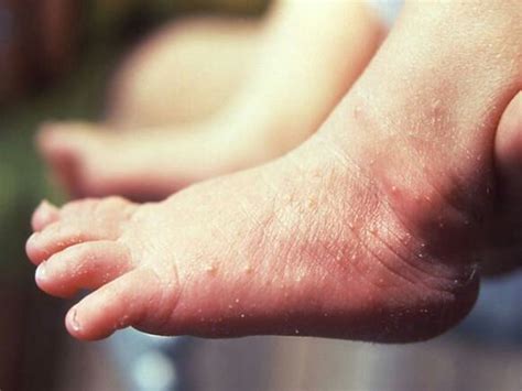 Tiny Red Bumps On Hands And Feet Babycenter