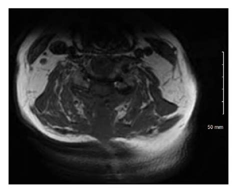 T1 Sequence Mri Of The Cervical Spine Obtained 2 Months Download