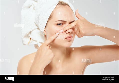 A Woman With A Towel On Her Head Squeezes Out Acne On Her Face Problem