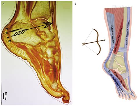 P45 Technology Reveals Bow And Arrow Sign In Human Ankle Chinese