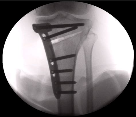 Knee Treatments Northampton Orthopaedics