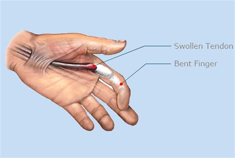 Trigger Finger Treatment South Florida Hand Center