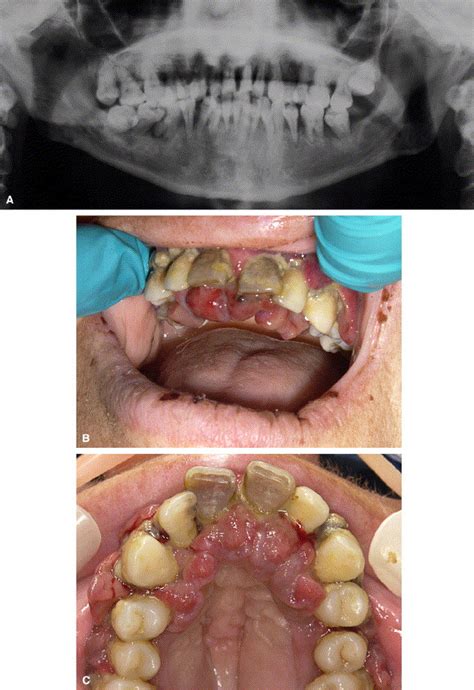 Identification And Treatment Of Scurvy A Case Report Oral Surgery