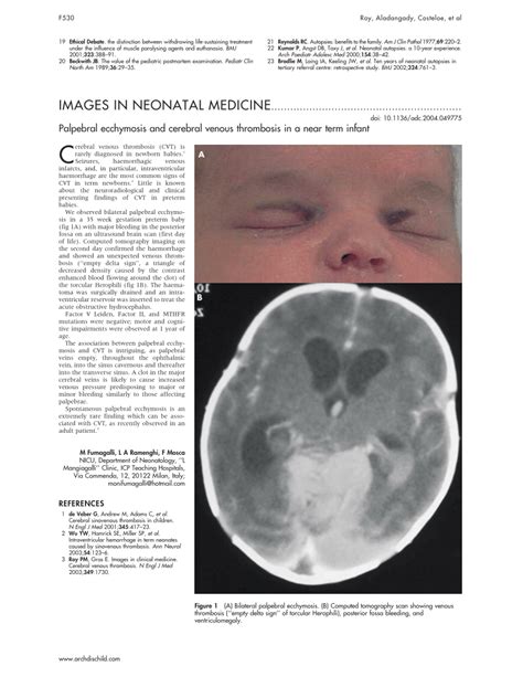 Pdf Palpebral Ecchymosis And Cerebral Venous Thrombosis In A Near