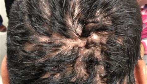 Clinical Challenge Recurring Pus Bumps On The Scalp Mpr