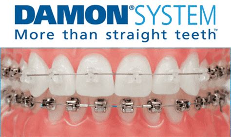 Damon® Braces Transforming Smiles South Bay Dentistry And Orthodontics