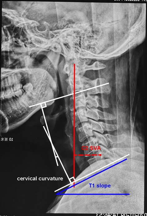 Measurement Of Cervical Sagittal Alignment Parameters The White Lines