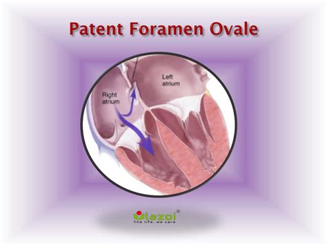 Patent Foramen Ovale Pictures