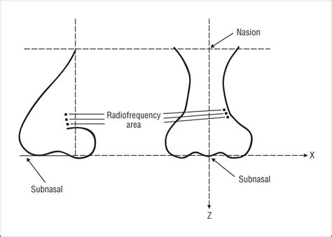 A New Surgical Method Of Dynamic Nasal Valve Collapse Facial Plastic