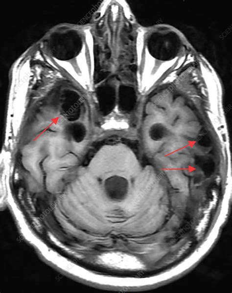 Chronic Post Traumatic Brain Injury Mri Stock Image C0306068