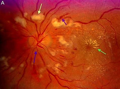 A Bilateral Macular Star And Optic Disc Oedema The Bmj