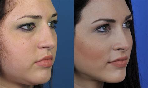 Long Term Cosmetic Rhinoplasty Beautiful Results