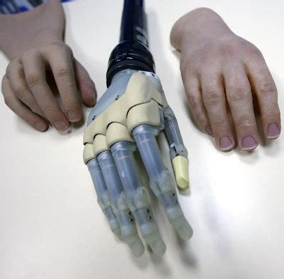 Medicina para el siglo XXI Primera mano biónica implantada a un