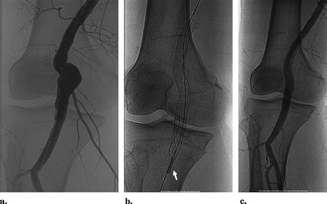 Endovascular Treatment Of Popliteal Artery Aneurysms A Single Center