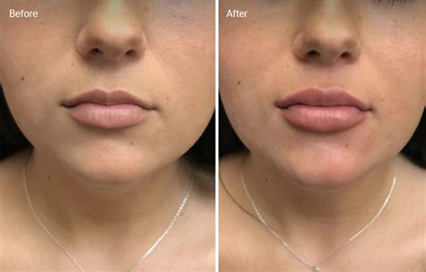 Lip Fillers How Long They Last Before And Afters Side Effects Cost