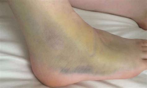 Ankle Sprains The Buxton Osteopathy Clinic