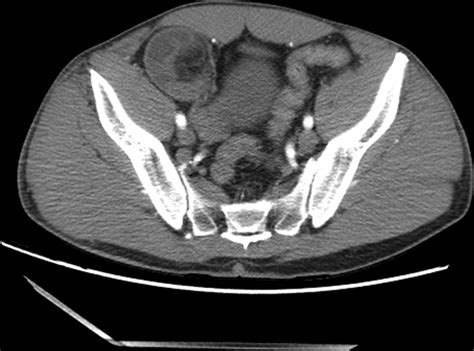 Reduction En Masse Of Inguinal Hernia A Review Of A Rare And Potential Fatal Complication