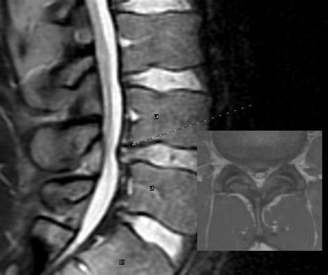 Mri Image Of My Herniated Disc L4 L5 Scott Flickr