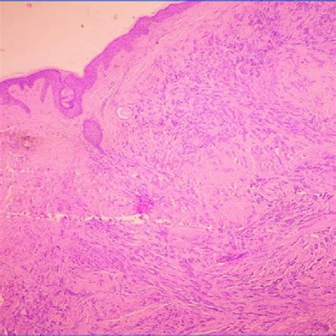 Primary Scalp Tumor Showing Neoplastic Infiltration He 10x Download