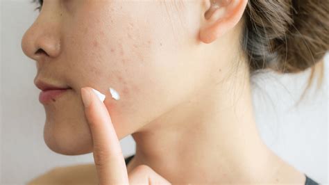 There is no physical testing kit sent to you. How a Food Intolerance Test Could Clear Up Your Acne ...
