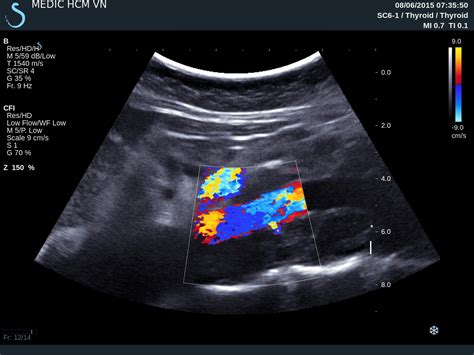 Vietnamese Medic Ultrasound Case 318 Diffuse Lymphadenopathy Dr