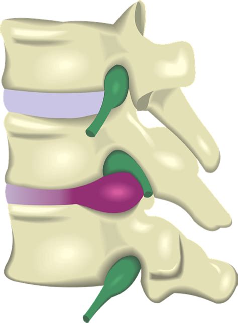 Cervical Radiculopathy Nerve Root Compression