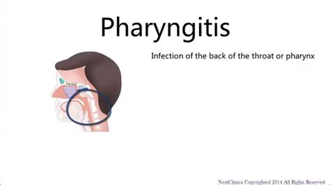 Viral Pharyngitis Youtube