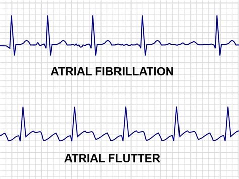 Afib And Atrial Flutter