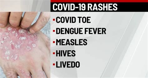 Rashes Are A Possible Symptom Of Coronavirus Dermatologists Say Wish