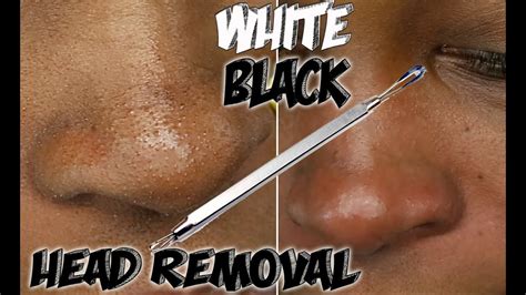 How To Get Rid Of Black And White Heads Quick And Easy Step By Step