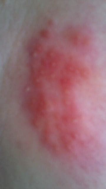 I Have A Blister Rash On My Back The Blisters Are Clear And
