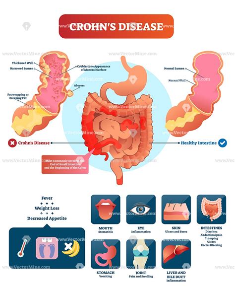 Crohns Disease Anatomical Vector Illustration Infographic Crohns Disease Crohns Crohns
