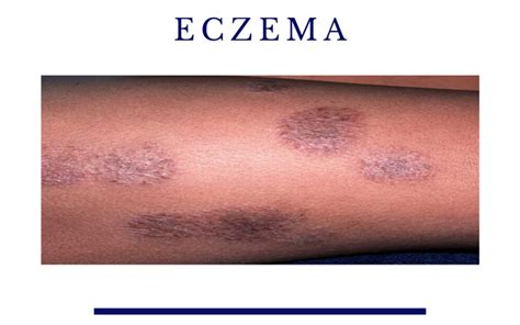 Types Of Eczema Joburg Dermatologist