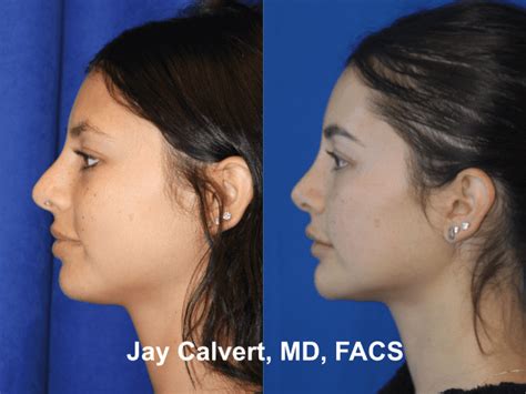 Rhinoplasty Beverly Hills Best Nose Job Dr Jay Calvert