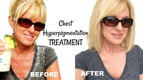 Get Rid Of Chest Hyperpigmentation And Sun Damage Youtube