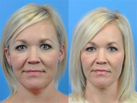 FaceTite™ Before & After Pictures in Indianapolis, IN