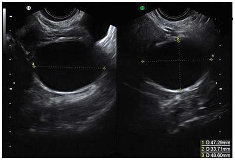 Types Of Ovarian Cysts Ultrasound