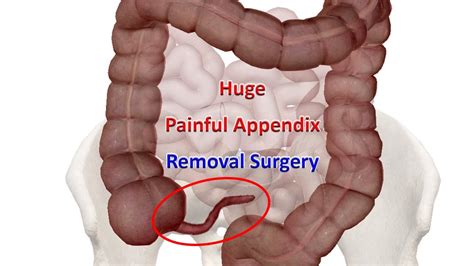 Laparoscopic Appendectomy For Enlarged Appendix Surgical Video How