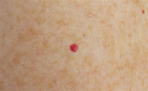 Cherry Angioma Pictures How To Remove A Cherry Angioma Dermahealth