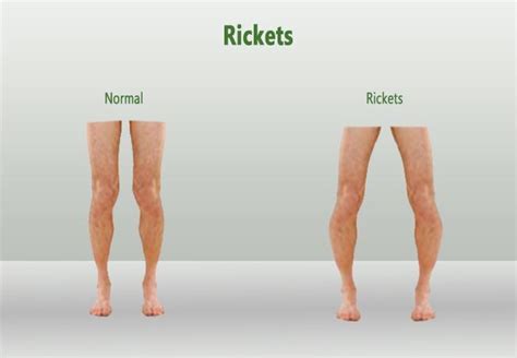 Top 5 Signs And Symptoms Of Rickets