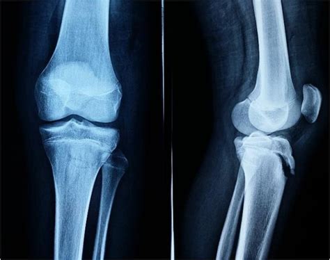 X Ray Knee Injury