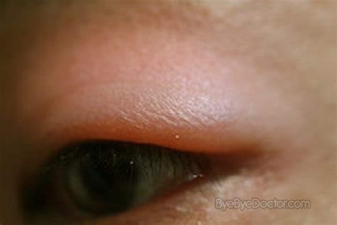 Swollen Eyelid Treatment Causes Pictures Symptoms Remedies