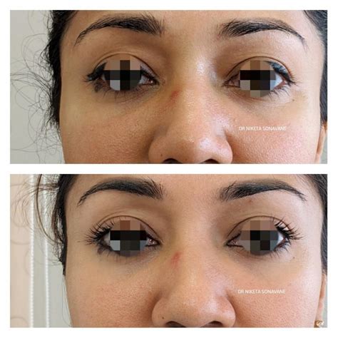 Pigmentation Treatment In Mumbai Cost Before And After Results