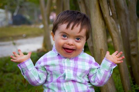 What Is Down Syndrome Shreeansh Fetal Medicine Center