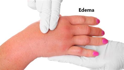 What Is Edema Symptoms Causes And Risk Factors The Inside Experience