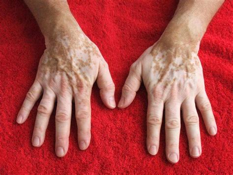 Flecken Auf Der Haut Vitiligo Ist Kein Grund Für Schiefe Blicke