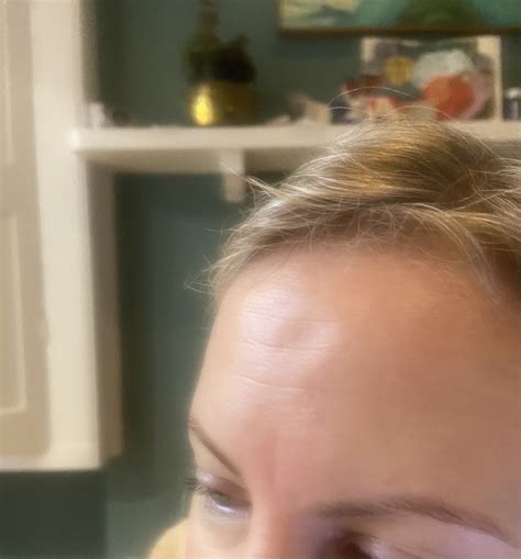 Verbesserung Schande Nuklear Woke Up With A Dent In My Forehead